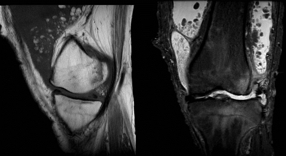 Radshare SYNOVIAL CHONDROMATOSIS