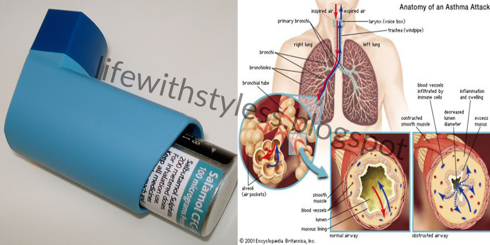No Need of Inhalers, Best Natural Way Will Totally Cure Asthma Attacks