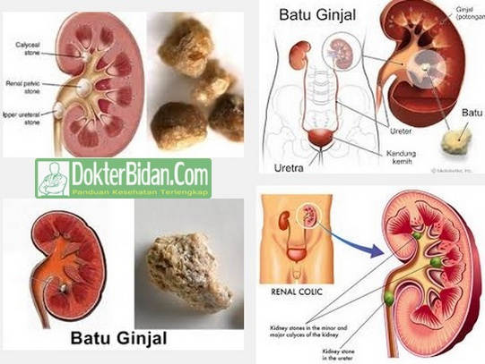 Batu Ginjal - Penyebab Gejala Kompikasi Dan Cara Mengobatinya Secara Alami Tradisional Tanpa Operasi Batu Ginjal - Penyebab Gejala Kompikasi Dan Cara Mengobatinya Secara Alami Tradisional Tanpa Operasi