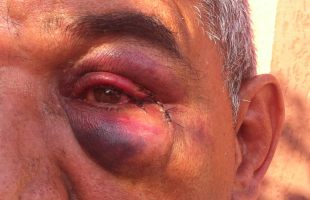Homem espancado pela Polícia Militar de Araraquara