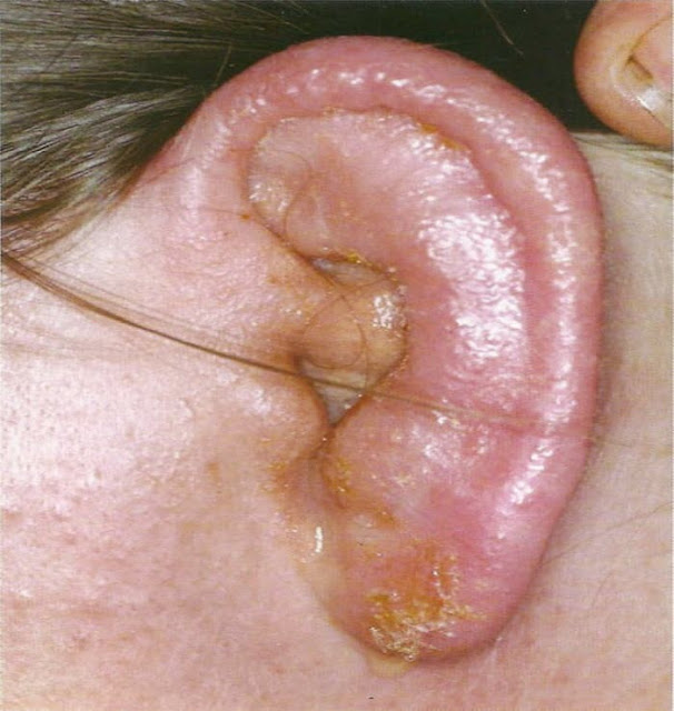 التهاب-الأذن-الخارجية-الحادّ