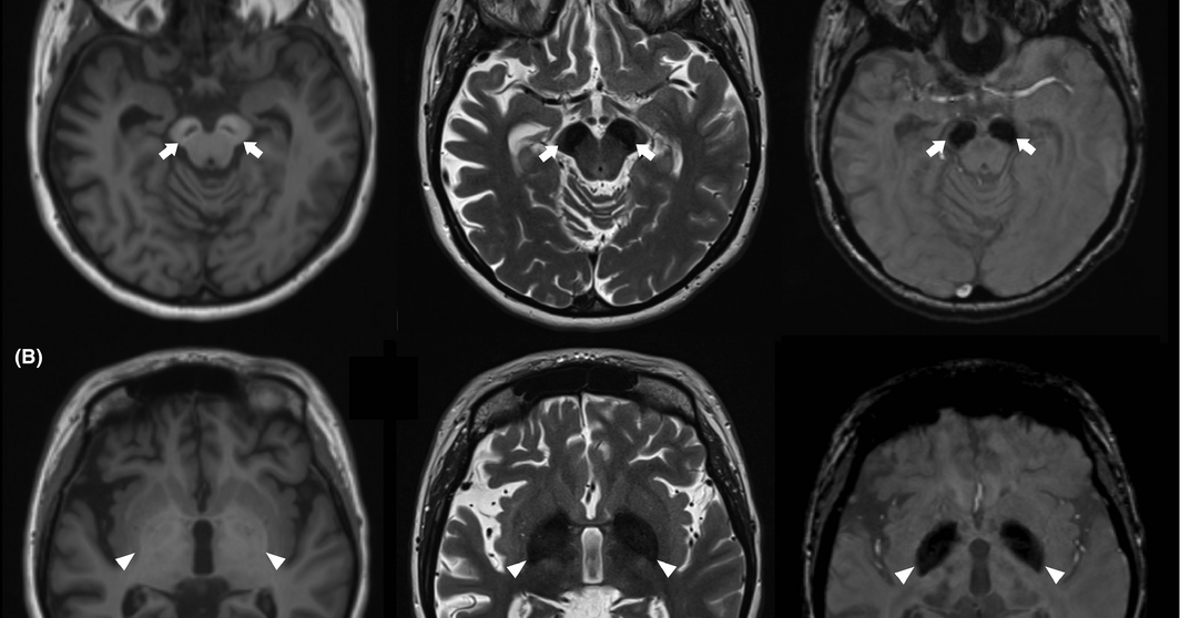 pediatric neurology Betapropeller proteinassociated neurodegeneration