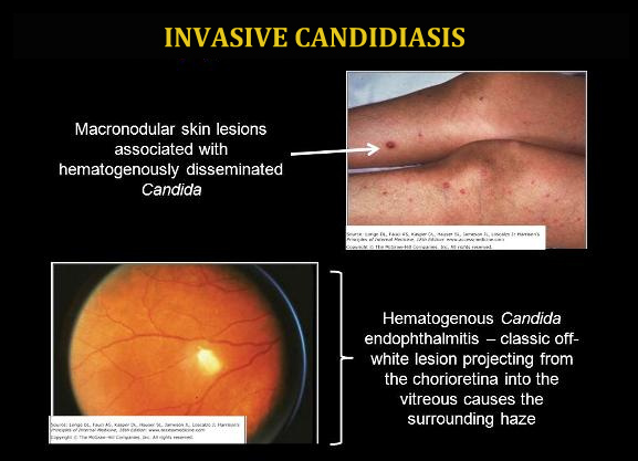 Invasive Candidiasis, A Hematogenous Dissemination of Candida