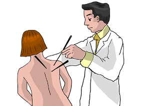 Acupuncture Therapy Acupuncture Therapy