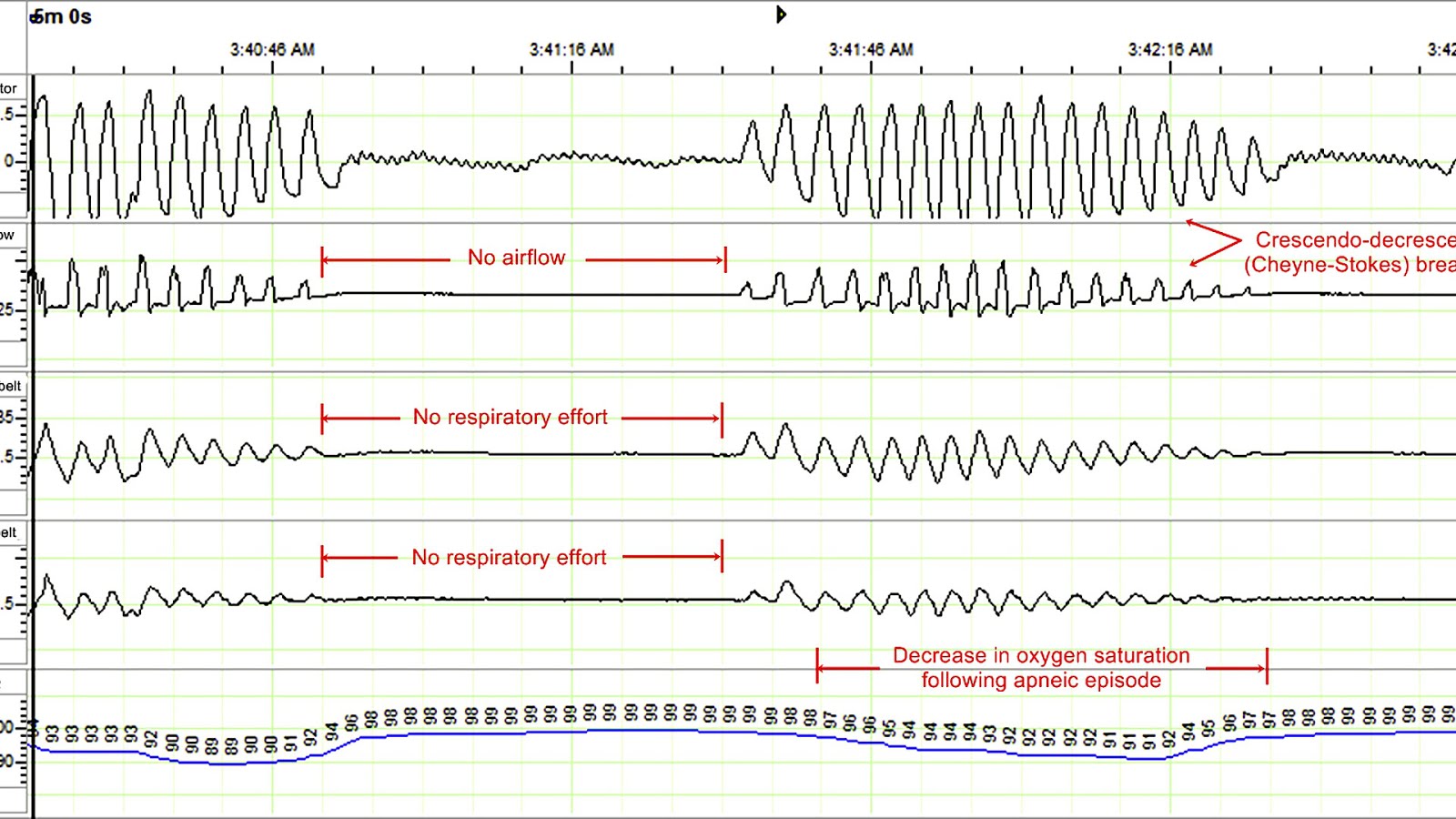 Central Sleep Apnea And Heart Failure Hear Choices