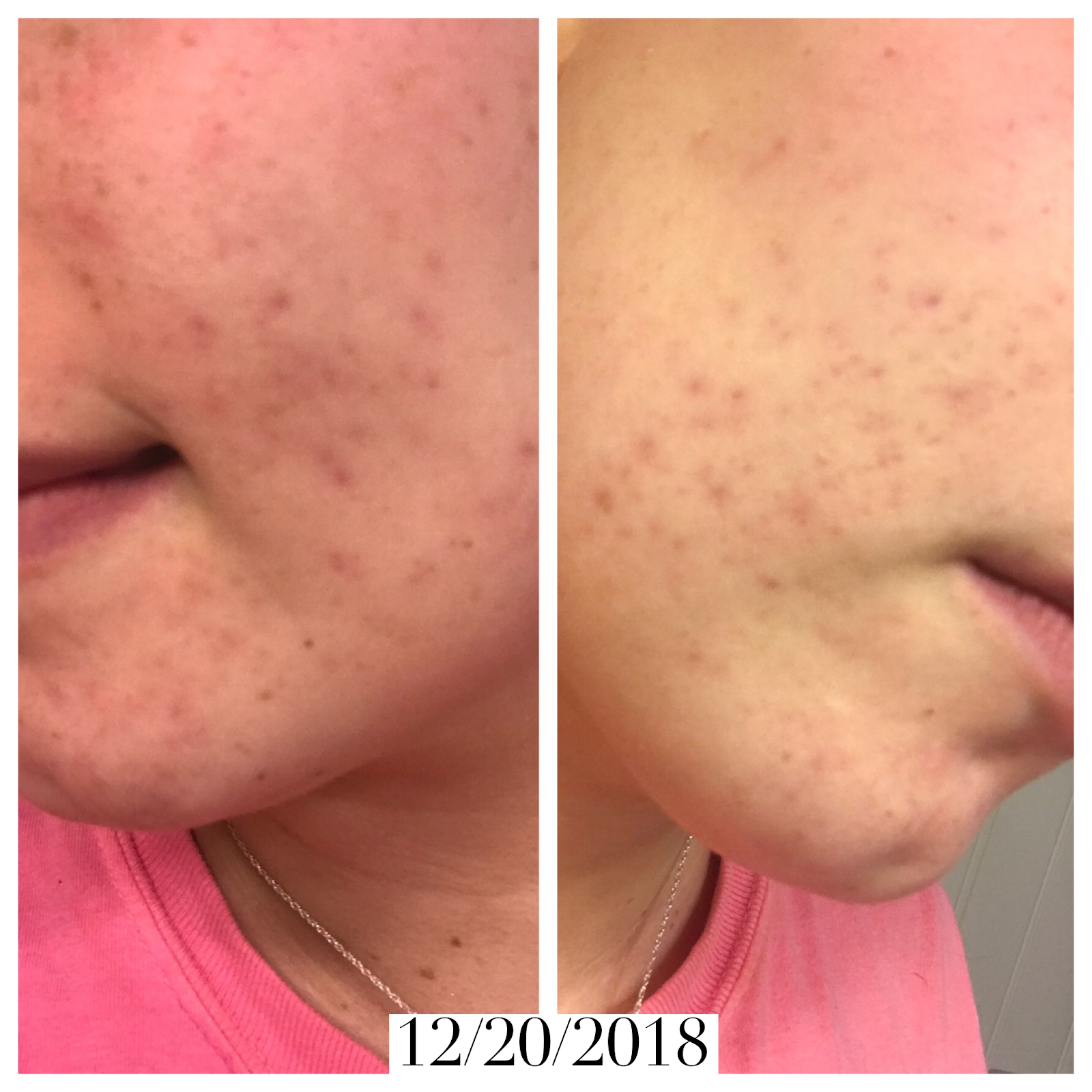 Love Our Love The Most My Struggle with Postpartum Acne & the Holy