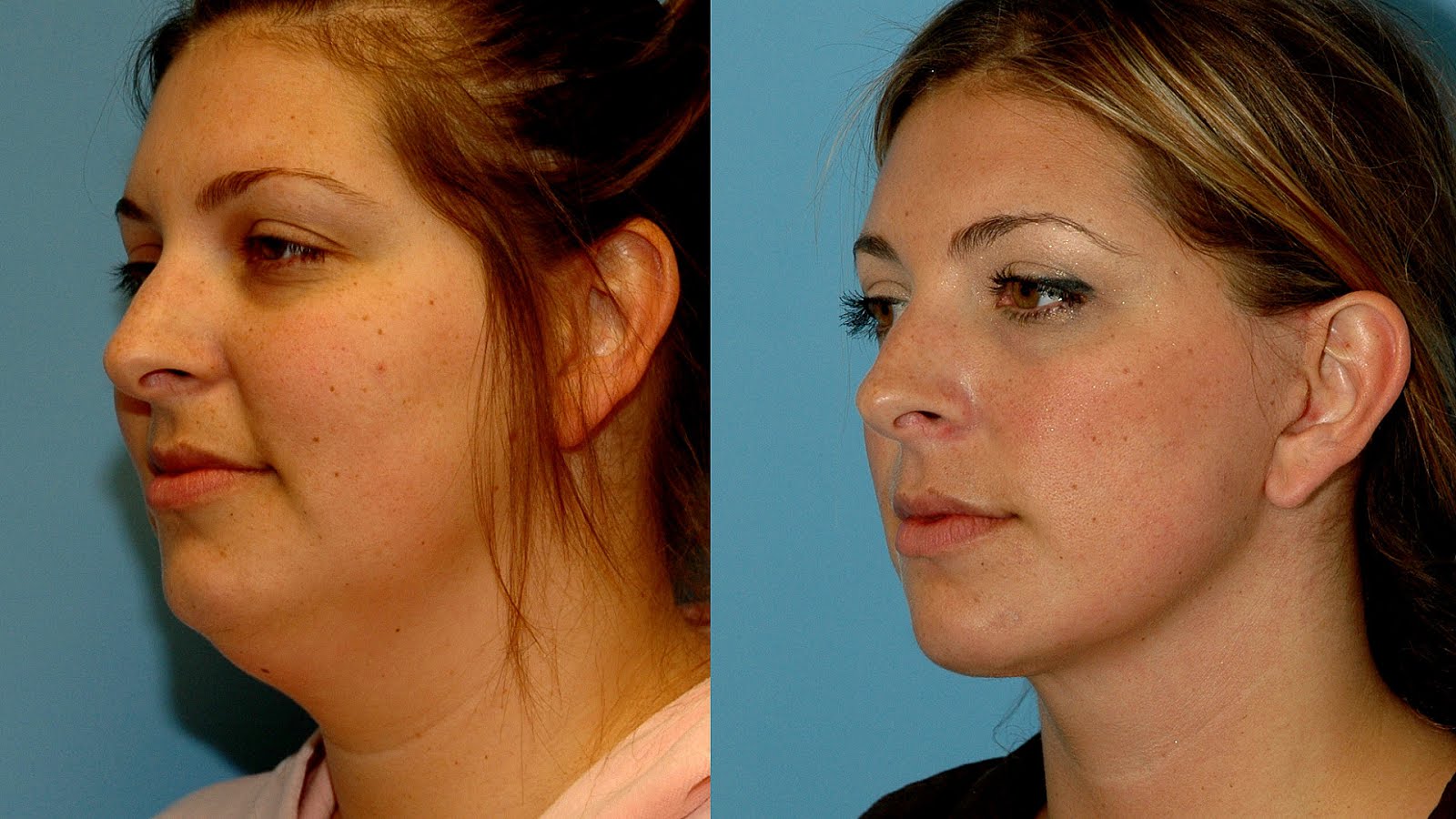 Recovery Time For Face And Neck Lift - Lift Choices