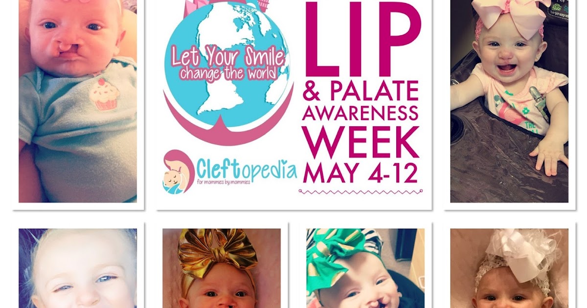 Cleft Lip and Palate Awareness Week How's Hudsyn??