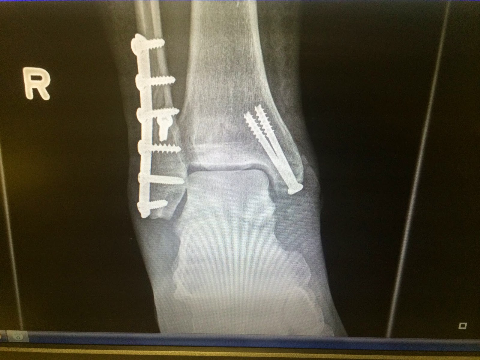 My Stupid Broken Ankle My Broken Ankle Week 2