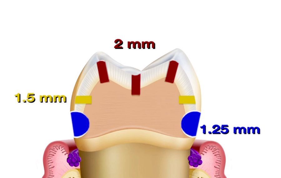 FIXED PROSTHODONTICS Reverse Preparation & Two Cord Impression