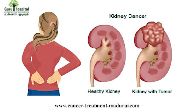 http://cancer-treatment-madurai.com/types-of-cancer-kidney-cancer.html