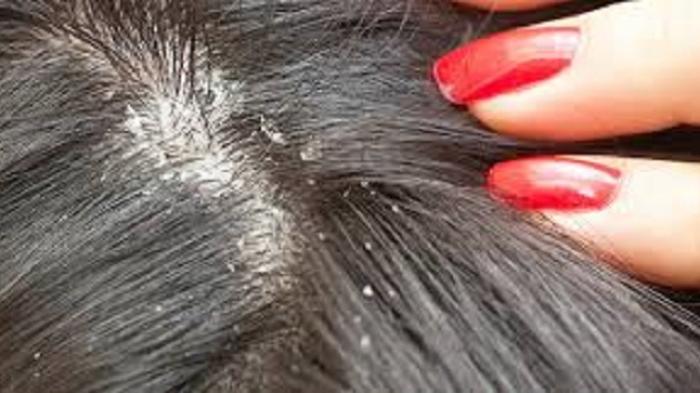 Karena Kutu Rambut Seorang Ibu Harus Meninggal