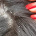 Karena Kutu Rambut Seorang Ibu Harus Meninggal