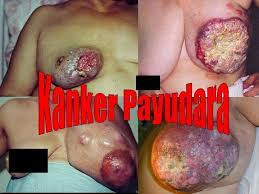 Tips Bagaimana Cara Untuk Mencegah Kanker Payudara Alami Yang Benar