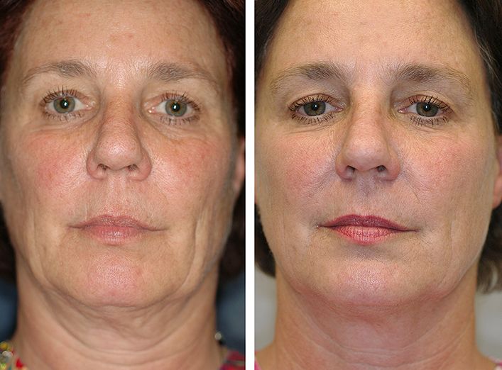 exercise facial work Exercise facial work