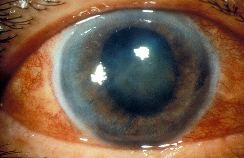 Gejala Pencegahan dan Pengobatan Penyakit Glaukoma