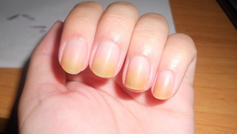 Your nails will turn yellow 12 Ways Smoking Cigarettes Ruins Your Looks