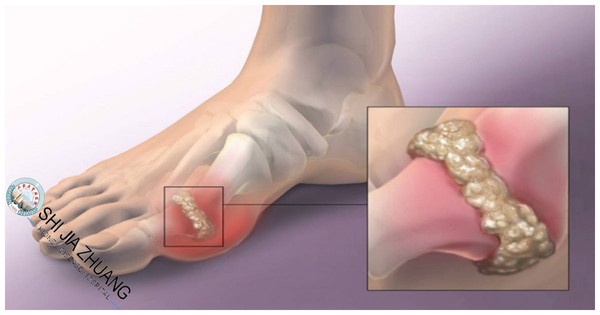 Dr.Anna_ShiJiaZhuang Kidney Disease Hospital Prevention of uric acid