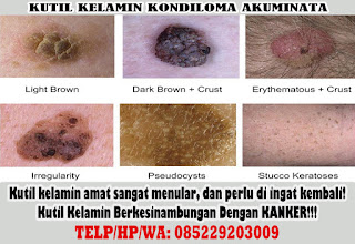 kutil kelamin: obat kutil kelamin ampuh alami terbaik terbukti aman dan terpercaya kutil kelamin: obat kutil kelamin ampuh alami terbaik terbukti aman dan terpercaya