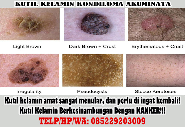 kutil kelamin: obat kutil kelamin ampuh alami terbaik terbukti aman dan terpercaya kutil kelamin: obat kutil kelamin ampuh alami terbaik terbukti aman dan terpercaya