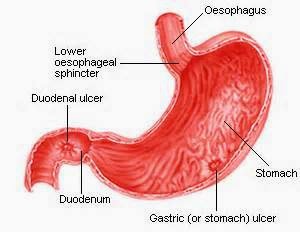 ulcer-in-the-stomach