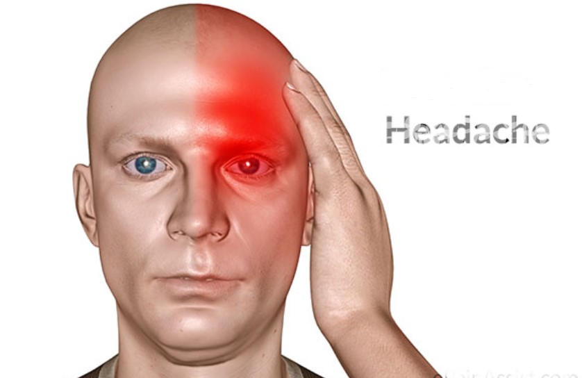 Cara Mengobati Sakit Kepala Secara Alami