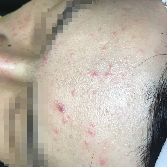 顏之鑽高雄美容做臉清粉刺除痘痘護膚SPA,奎蒂絲杏仁酸精華液, 高雄左營岩盤浴推薦, 高雄全身去角質推薦, 高雄美容沙龍推薦, 高雄美容SPA推薦, 高雄做臉清粉刺推薦, 高雄WAXXXX熱蠟除毛推薦, 顏之鑽高雄美容做臉清粉刺除痘痘護膚SPA,高雄左營美容店,左營美容SPA護膚, 高雄左營做臉,高雄左營做臉推薦,高雄左營做臉分享,高雄左營做臉評價,高雄左營做臉價格, 高雄左營清粉刺,高雄左營清粉刺推薦,高雄左營清粉刺店家,高雄左營清粉刺推薦店家,高雄左營清粉刺價格, 高雄左營清粉刺評價,高雄左營清粉刺分享,高雄左營清粉刺便宜,高雄左營無痛清粉刺,高雄左營擠粉刺, 高雄左營美顏店推薦,高雄左營美顏店家, 高雄左營美容店推薦, 高雄左營熱蠟除毛,高雄左營熱蠟除毛便宜,高雄左營熱蠟除毛分享,高雄左營熱蠟除毛評價,高雄左營熱蠟除毛價格, 高雄左營熱蠟除毛推薦,高雄左營蜜蠟除毛評價,高雄左營蜜蠟除毛便宜,高雄左營蜜蠟除毛價格,高雄左營蜜蠟除毛推薦, 高雄左營腋下除毛評價,高雄左營腋下除毛推薦,高雄左營腋下除毛價格,高雄左營腋下除毛分享,高雄左營腋下除毛便宜, 高雄左營私密處除毛評價,高雄左營私密處除毛推薦,高雄左營私密處除毛價格,高雄左營私密處除毛便宜, 高雄左營岩盤浴SPA,高雄左營岩盤浴,高雄左營岩盤浴推薦,岩盤浴高雄左營