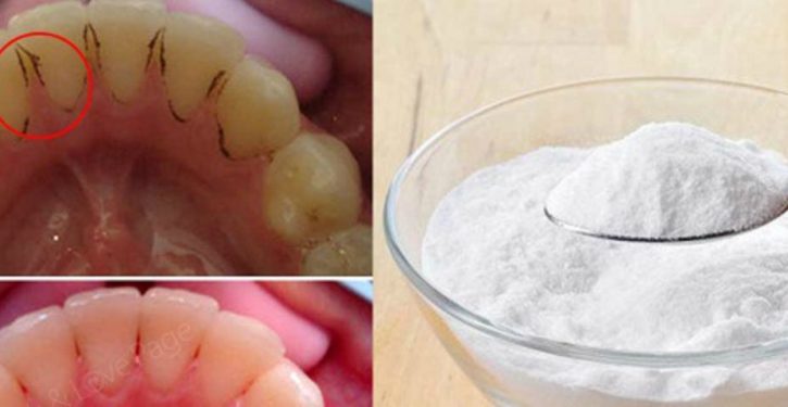 Here's How To Whiten Yellow Teeth, Remove Plaque And Tartar Buildup