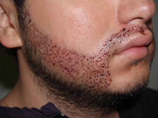 Man And His World An Option For Men Who Lack Hair Beard Transplants