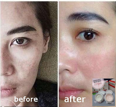 Cream Wajah Permanen Dan Praktis Atasi Bintik Hitam Pada Wajah Cream Wajah Permanen Dan Praktis Atasi Bintik Hitam Pada Wajah