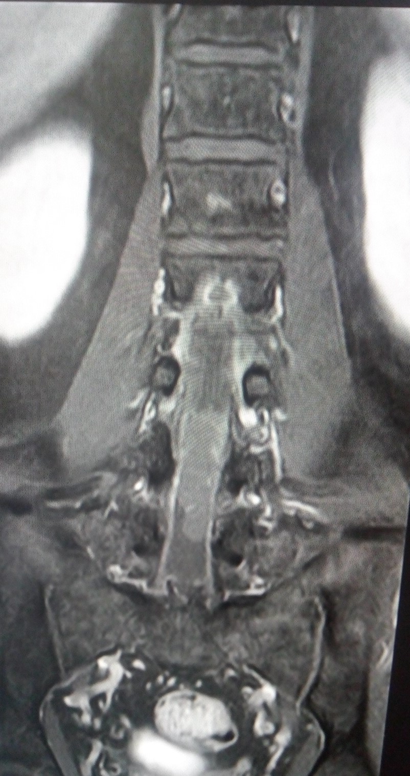 Cauda equina mass An Approach Sumer�s Radiology Blog