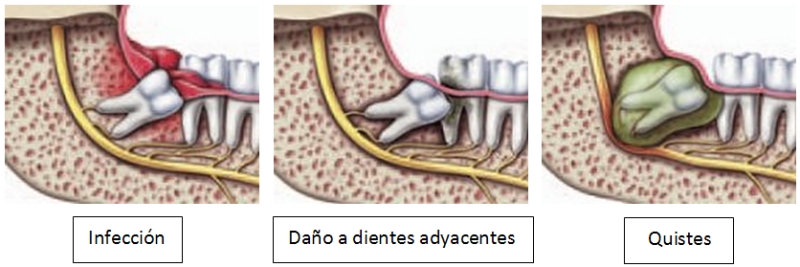 Muelas del juicio cuanto dura la inflamacion