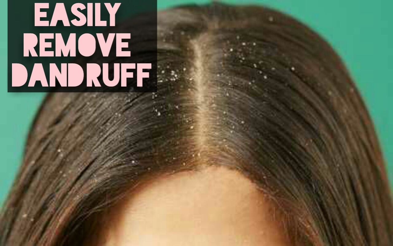 health and beauty tips Best treatment for dandruff with home remedies