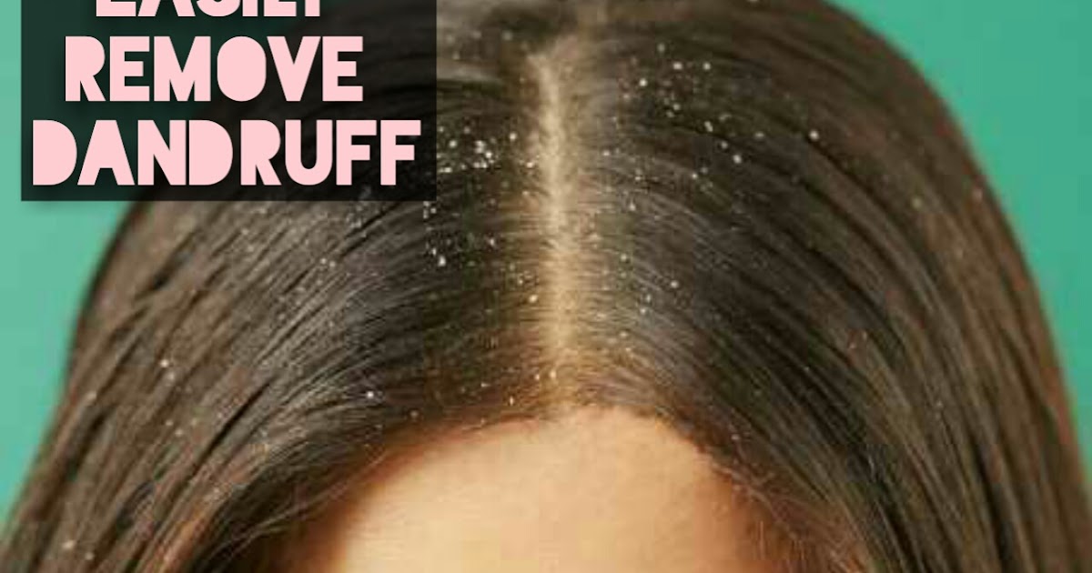 health and beauty tips Best treatment for dandruff with home remedies