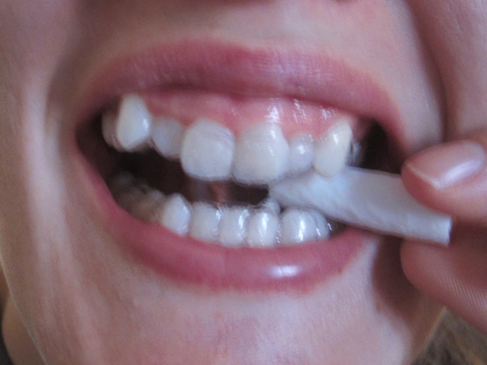 Creatively Titled Blog about Invisalign: Tray 1