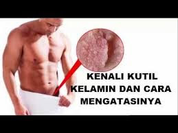 Foto Ciri-Ciri Kutil Kelamin Pada Pria seperti jengger ayam