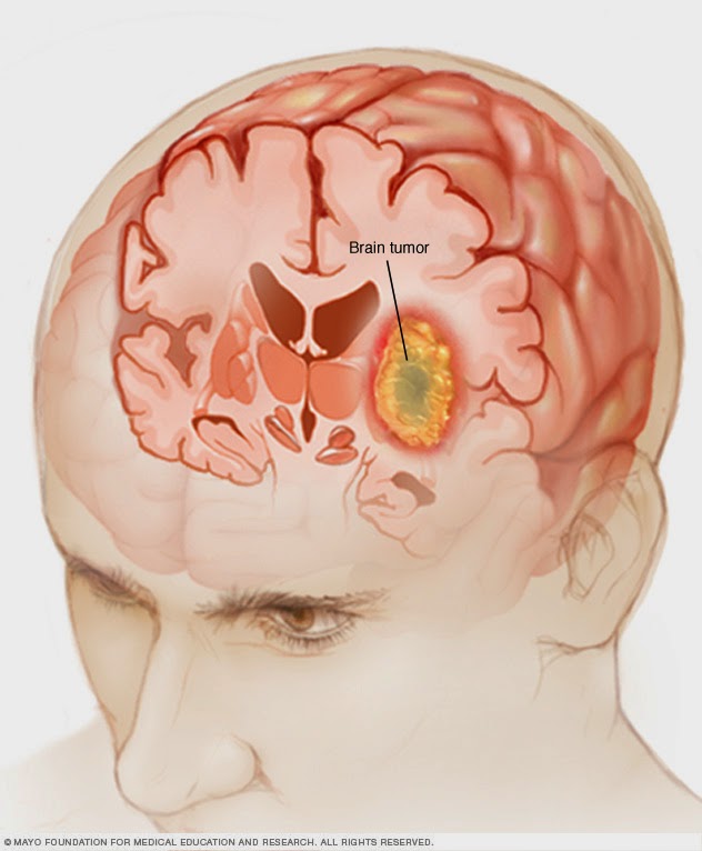 Brain Cancer Brain Tumor Types And Treatment Options