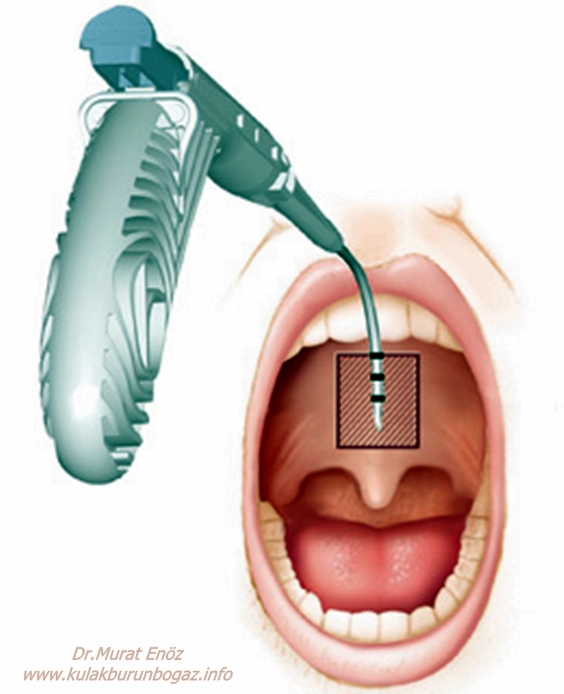 Pillar Implant System (Pillar Procedure)