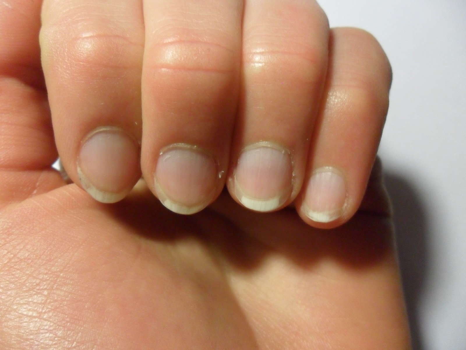 Terrys nails of witte nagels - Medische Forum - Dokter.nl