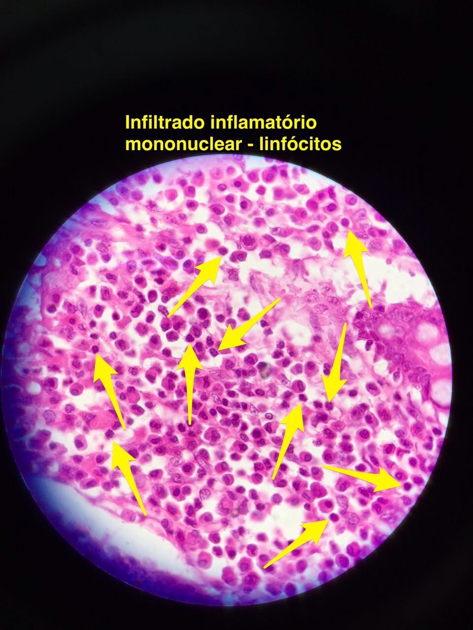 HISTOLOGIA90: HISTOLOGIA DO SISTEMA LINFOIDE - INFLAMAÇÃO CRÔNICA