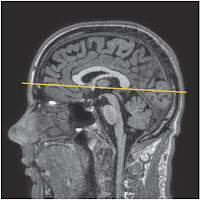 Head scan MRI