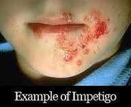 impetigo home remedies: August 2011