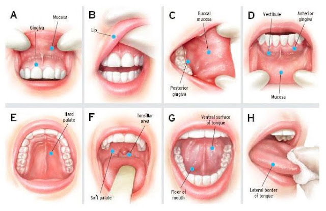 6 Gejala yang Harus Dikenali Kanker Lidah Yang Tak Bisa Disepelekan Seperti Yang Dialami Pria Ini 6 Gejala yang Harus Dikenali Kanker Lidah Yang Tak Bisa Disepelekan Seperti Yang Dialami Pria Ini
