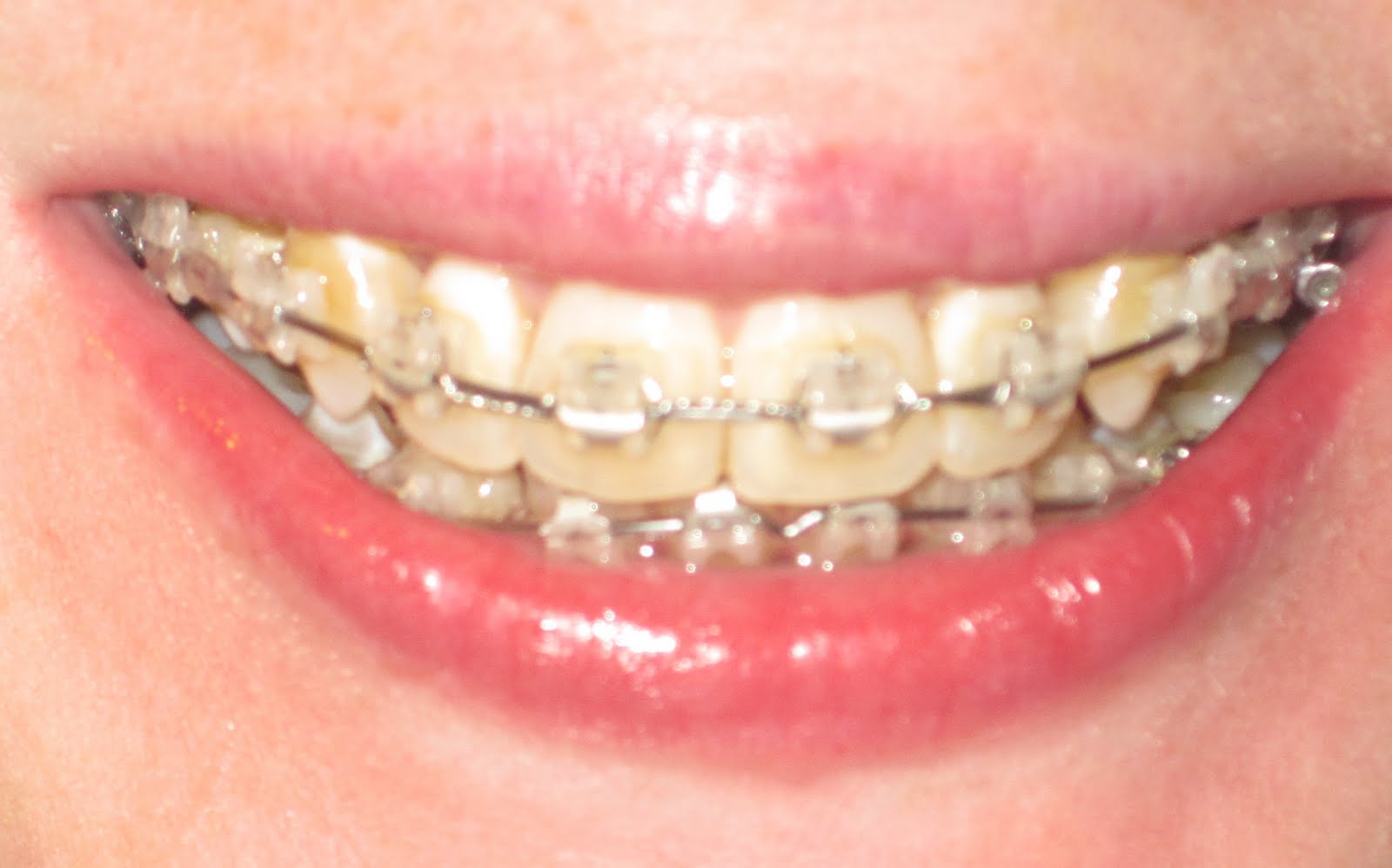 A 29 year old's braces diary...