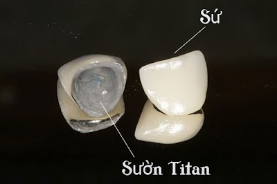 Loại răng sứ chất lượng với chi phí hợp lý hiện nay? Rang-su-titan