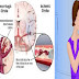 Menyesallah Anda Jika Di Abaikan..?? Ketahuilah Satu Bulan Sebelum Stroke, Tubuh Anda Akan Mengirimkan Tanda-Tanda Peringatan Ini..!!! Brikut Penjelasan'Nya: Tolong Sebarkan Agar Banyak Yang Tau..!!!!!