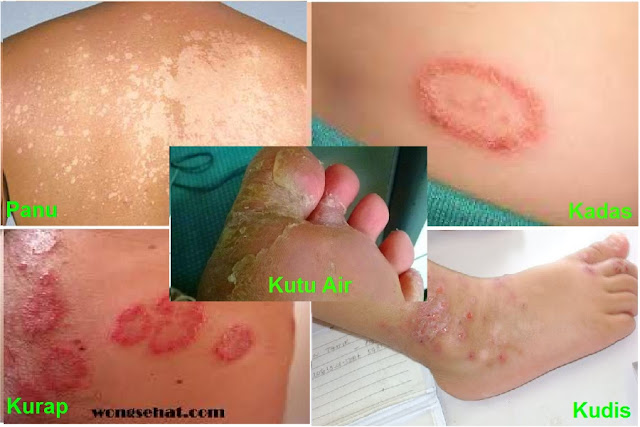 Obat Panu Kadas Kurab Tradisional - Marno Herbal