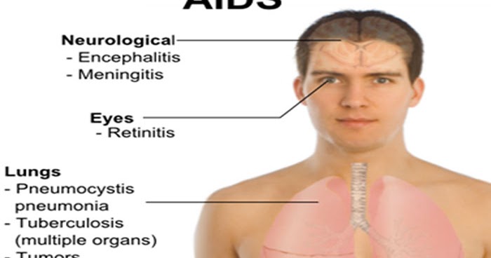 Can You Get Aids From Eating Or Drinking After Someone Can You Get Aids From Eating Or Drinking After Someone