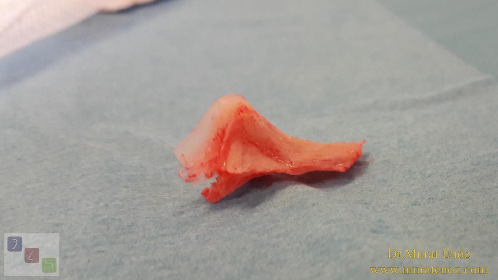 Ossified Overhang (Osteophyte) In The Nose That Can Cause Atypical