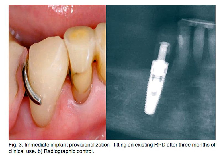 CLINICAL CASE A Chairside Technique to Preserve the Anatomy of the Pre